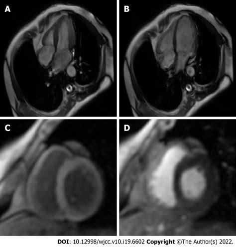 Unusual course of congenital complete heart block in an adult: A case ...