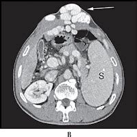 CT/MRI Clinicals: Caput Medusae