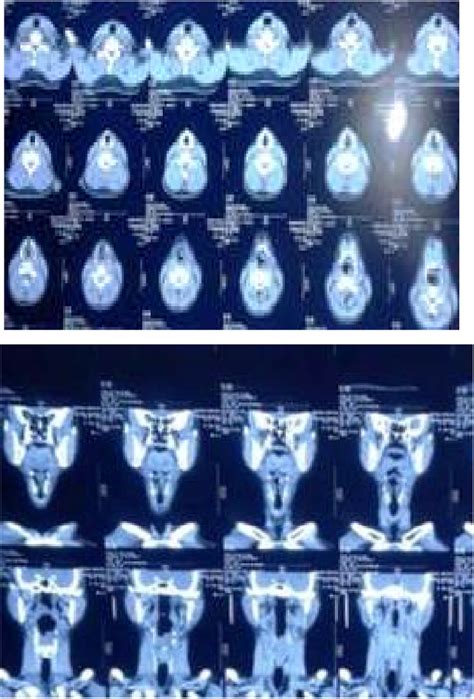 Computed Tomography (CT) scan showing mass. | Download Scientific Diagram