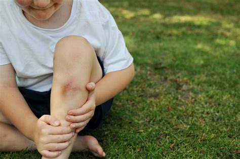 Childhood Injuries Stock Photo - Download Image Now - iStock