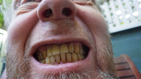 Yellow Teeth Free Stock Photo - Public Domain Pictures