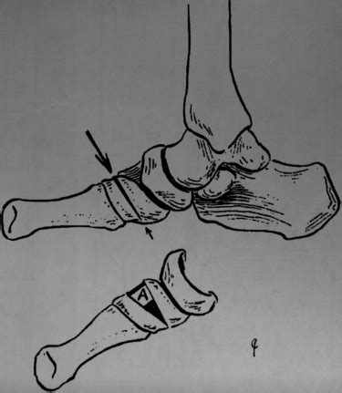 The Cotton Osteotomy: A Technical Guide - The Journal of Foot and Ankle Surgery