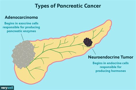 Pancreas Cancer