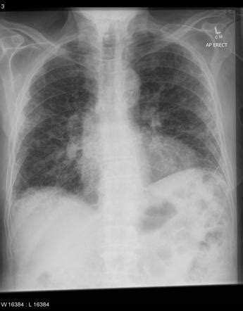 Interstitial Pneumonia X Ray