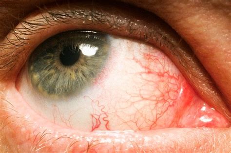 Your Eyes Reveal Symptoms Of Numerous Serious And Deadly Diseases That Can Bury You Under The ...