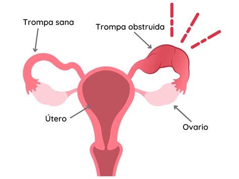 Obstrucción de las trompas de Falopio, causa frecuente de infertilidad