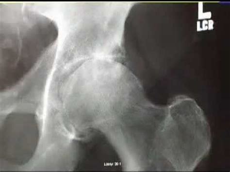 Diagnosing an Arthritic Hip Joint | Doovi