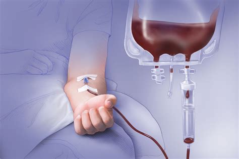 Mortality, Complications With Therapeutic Plasma Exchange for Acute Immune TTP - Hematology Advisor