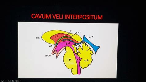 Cavum Velum Interpositum Ultrasound