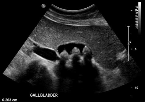 Cholelithiasis Ultrasound