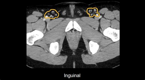 Inguinal Lymph Nodes Abdomen