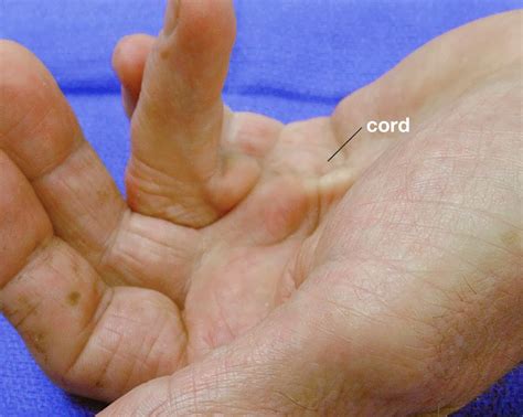 Dupuytren Contracture; A Connective Tissue Disorder - Dream Health