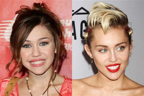 Miley Cyrus Veneers