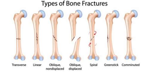 Fractures and Breaks - what's the difference? - Orthopaedic Surgery Associates