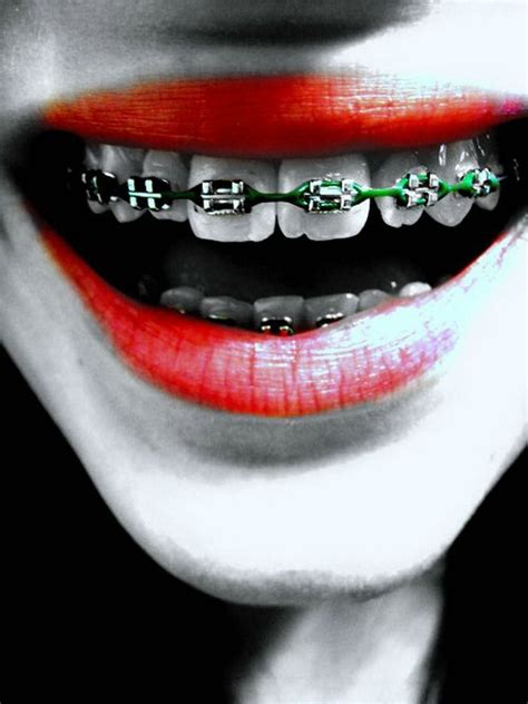 Green Braces Colours - Teeth Braces Ideas | Green braces, Braces colors ...