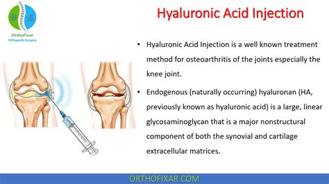 Hyaluronic Acid Injections: How Do They Treat Arthritis?, 43% OFF