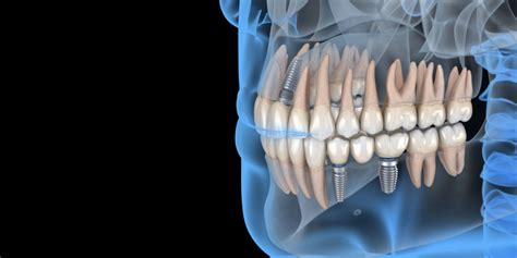 History Of Dental Implants | Huntington Beach CA | Dr. Nichols