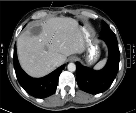 Liver Segments Ct