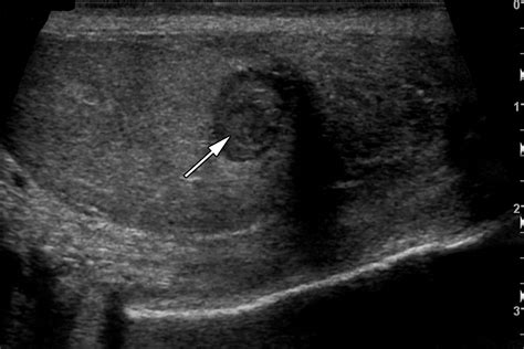 Testicular Seminoma and Its Mimics: From the Radiologic Pathology Archives | RadioGraphics