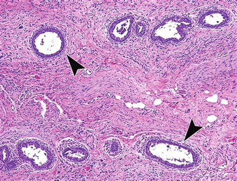 Bilateral Hypertrophy Of Both Breasts