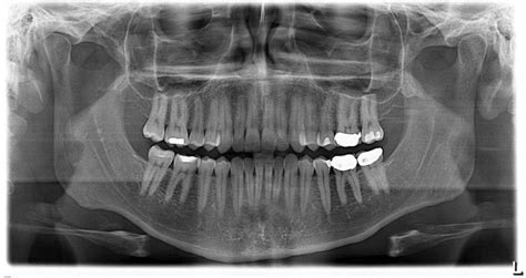 PANOREX | Advance Cosmetic & General Dentistry