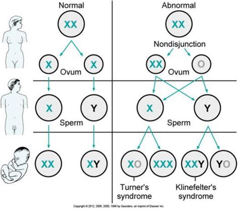 Turner Syndrome Diagram