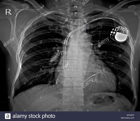 Implant Pacemaker Stock Photos & Implant Pacemaker Stock Images - Alamy