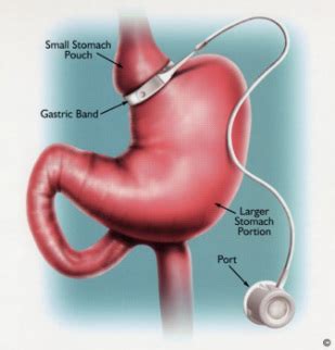 Gastric Banding - weight loss surgeries