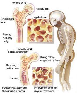 Paget's Disease of Bone - Jonathan Aarons MD/ Pain Management