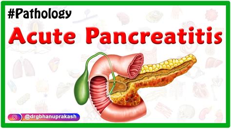 Acute Pancreatitis: Etiology , signs and Symptoms, pathophysiology , Diagnosis, Treatment - YouTube