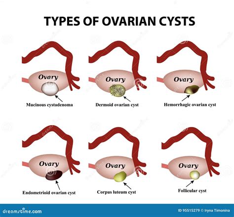 Types of Ovarian Cysts. Set. Infographics Stock Illustration - Illustration of eps10, hormone ...