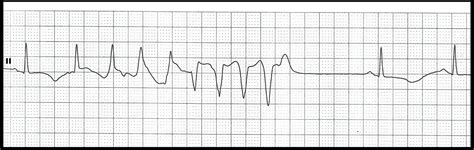 Float Nurse: ECG Rhythm Strip Quiz 120