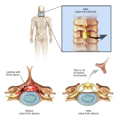 CERVICAL LAMINECTOMY AND FUSION | Manhattan Spine Consultants