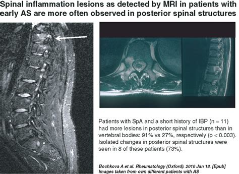 Imaging of axial spondyloarthritis including ankylosing spondylitis ...