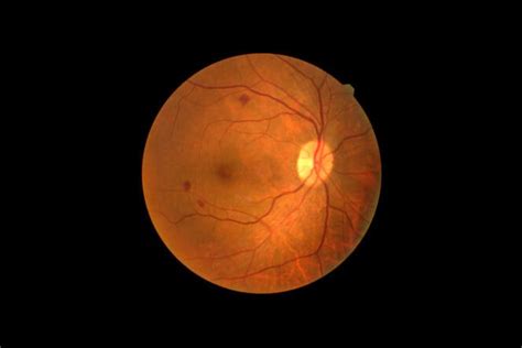 Retinopathy: Symptoms, Treatment, and Causes | MyVision.org