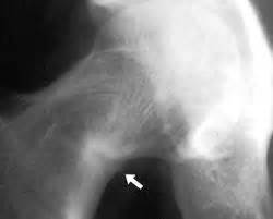 Femoral Neck Stress Fractures - Knee & Sports - Orthobullets