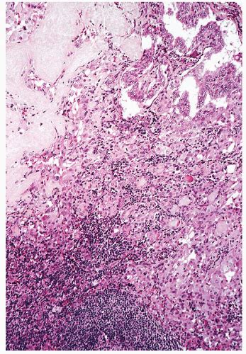 Medullary Carcinoma | Basicmedical Key