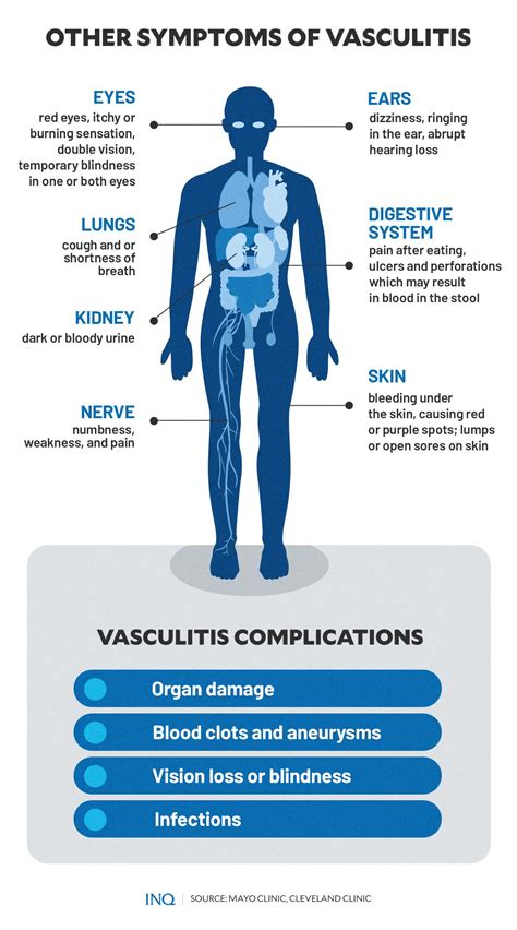 Vasculitis nearly turned Ashton Kutcher blind, paralyzed. What is it? - hearing-loss.news