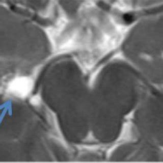 Choroidal fissure cyst | Download Scientific Diagram