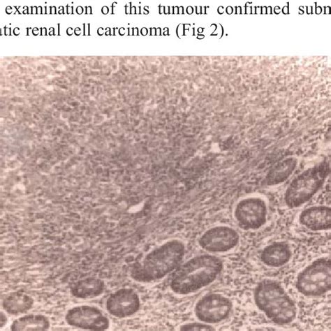 Histopathological section of renal cell carcinoma. Photomicrograph ...