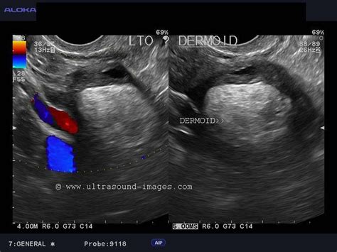 Ultrasound image gallery | Dermoid cyst, Ultrasound, Ovaries