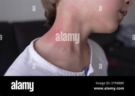 Allergic skin reaction on the childs neck and face - red rash. Symptoms of photodermatitis ...