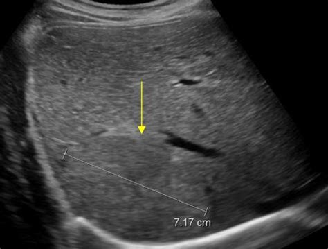 Focal nodular hyperplasia | Ultrasound Cases