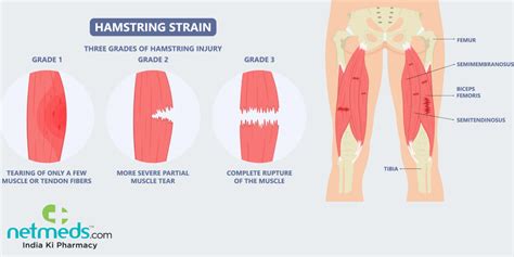 Leg Muscles Diagram Hamstring / Hamstring Injury Symptoms Recovery ...