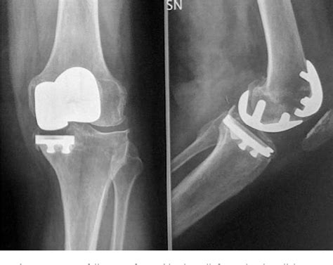 Figure 4 from Partial knee arthroplasty: patellofemoral arthroplasty and combined ...