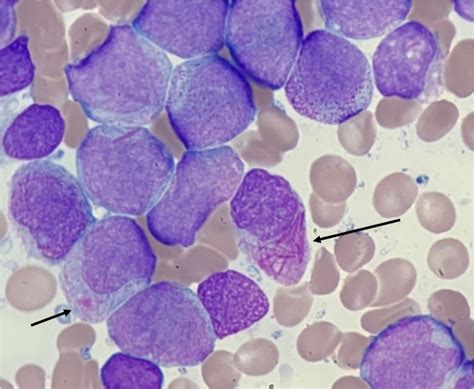 Acute promyelocytic leukaemia with t(15;17)(q22;q12);(PML::RARA ...