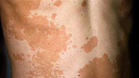 Discolored Skin Patches: Pictures, Causes, and Treatments