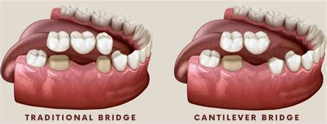 Cantilever Tooth Bridge At GM Dental In Rochester - Barnet (London ...