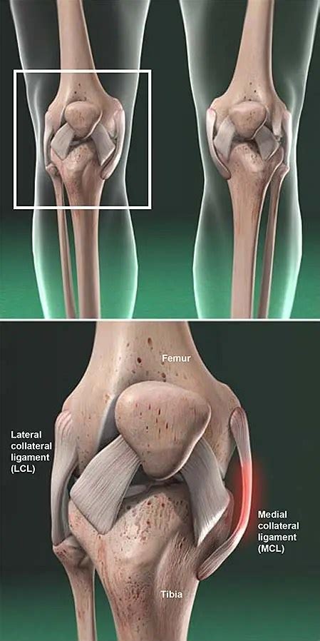 Lesión del ligamento colateral mediano (MCL) | Grupo médico ortopédico ...