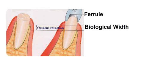 What is Ferrule in Dentistry? | News | Dentagama